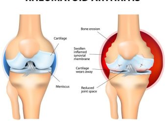 Artritis